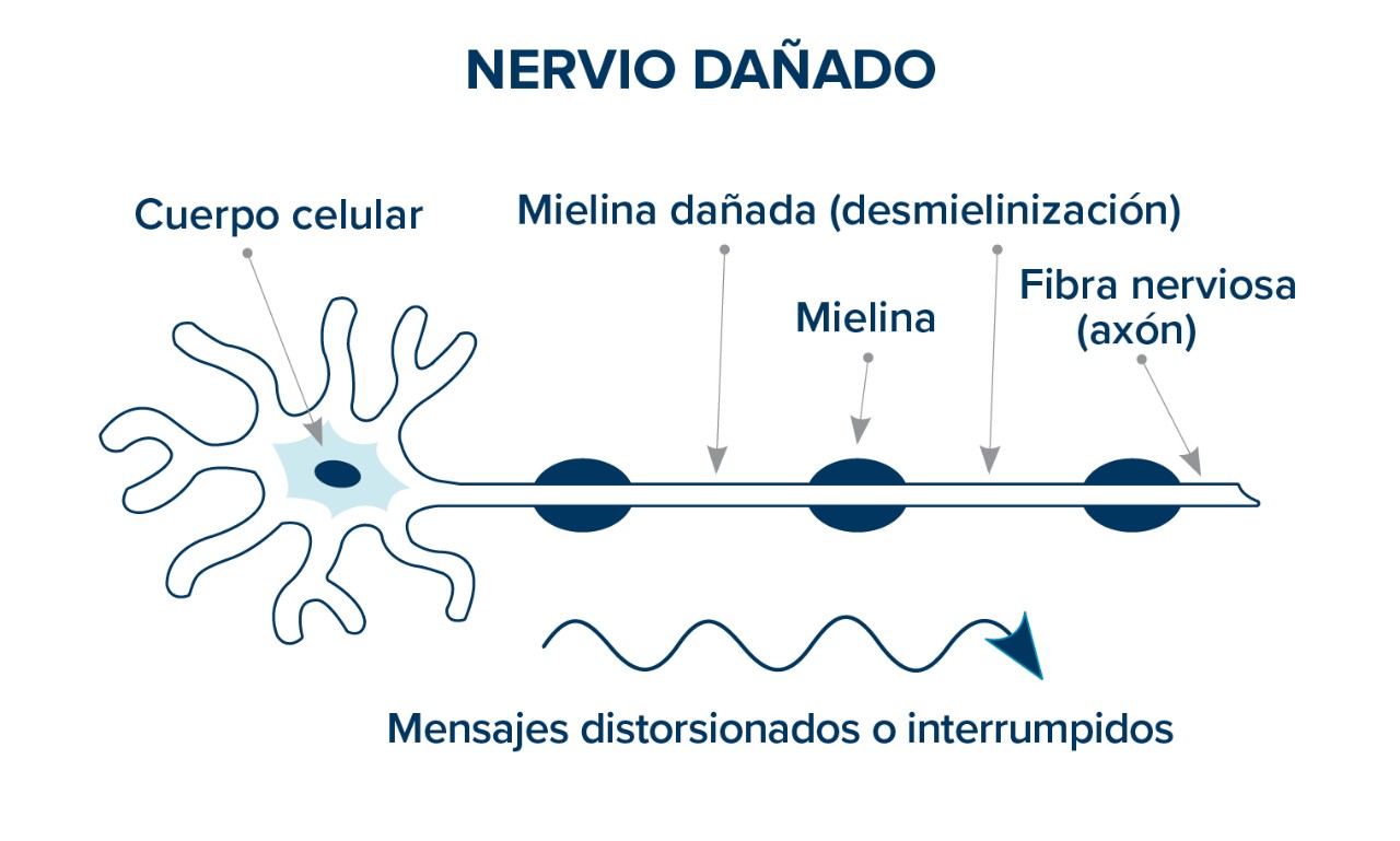 nervio dañado